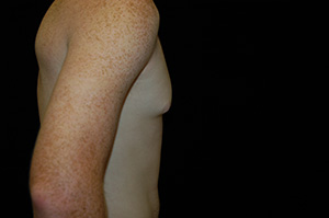 Gynecomastia 3c